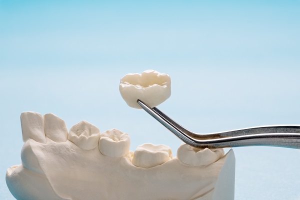 Can A Dental Crown Fail?