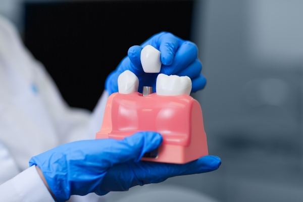 How Natural Does An Implant Crown Look?